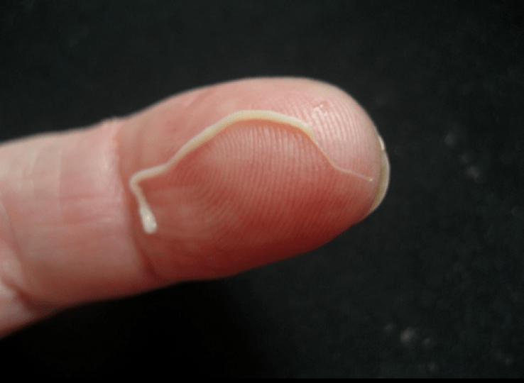 انگل کرم گرد از بدن انسان